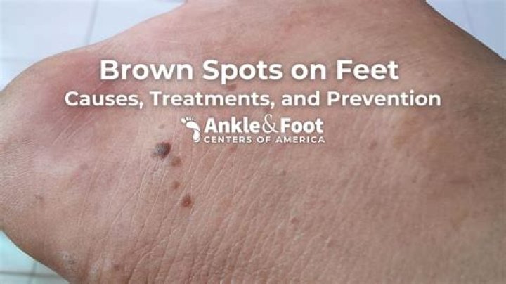 Can brown spots be removed?