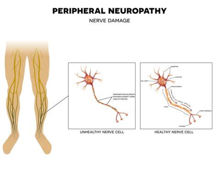 Can H wave help neuropathy?
