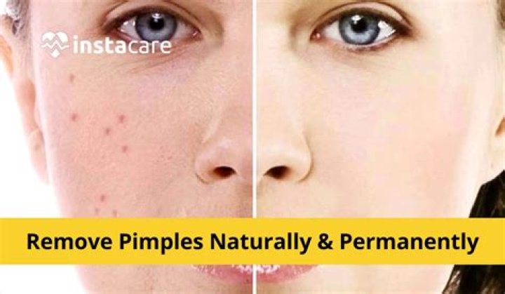 Can potato remove pimple marks?