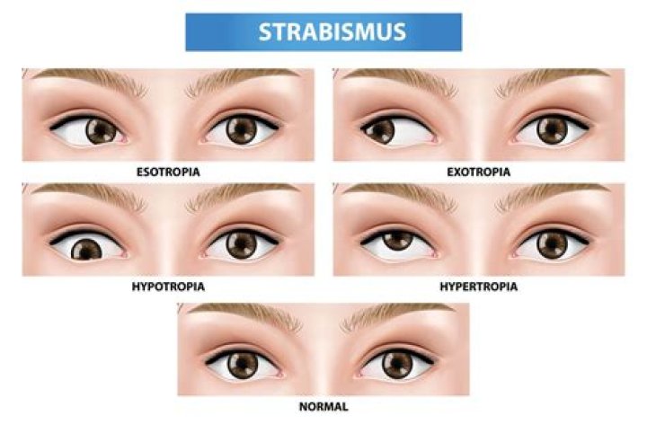 Can strabismus affect driving?