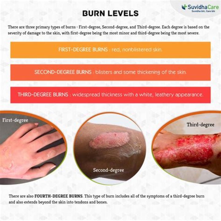 Can you survive sixth-degree burns?