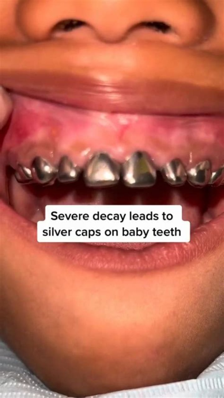 Do kids have to have silver caps?