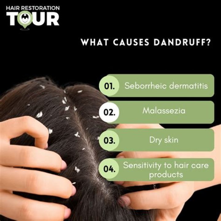 Does Head sweat cause dandruff?
