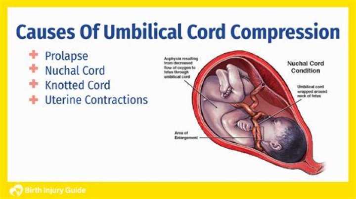 How do you cut an emergency umbilical cord?