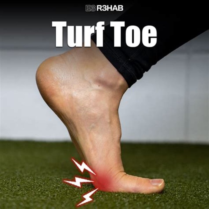 How do you know if you have turf toe?