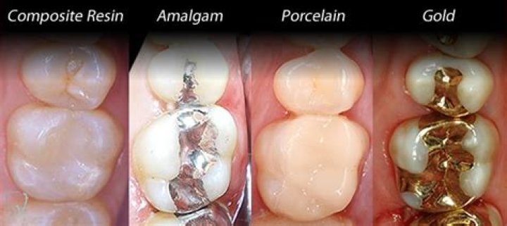 How long do silver fillings last?