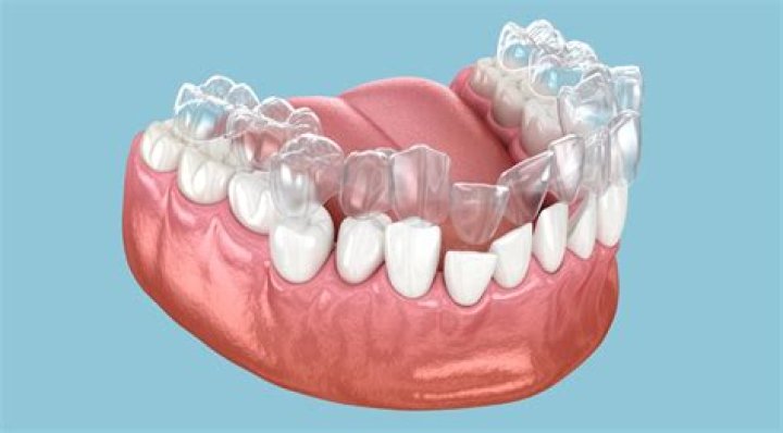 How long does Invisalign take to straighten teeth?
