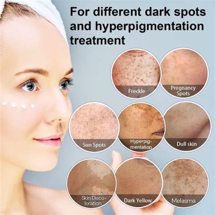 How long it takes for hyperpigmentation to fade?