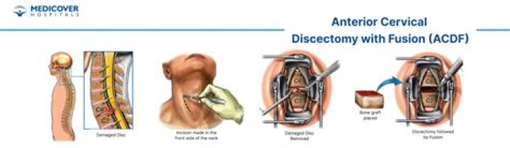 How serious is neck fusion surgery?