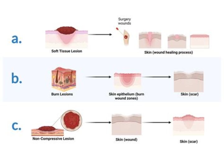 Is scar tissue soft or hard?
