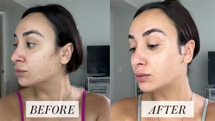 Should you use Retin-A every night?