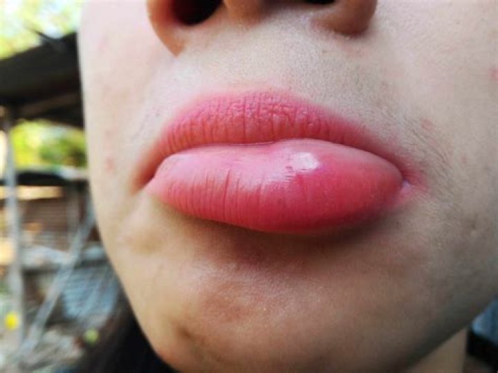 What causes lips to grow big?