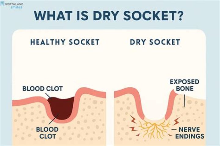What does dry socket pain feel like?