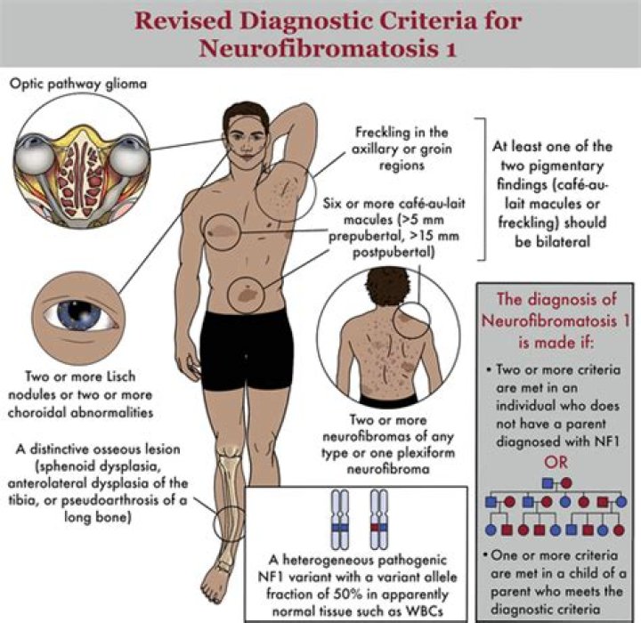 What does the start of neurofibromatosis look like?