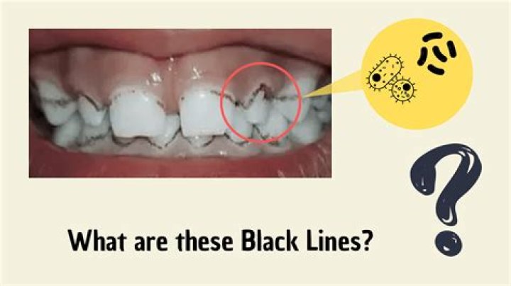 Why is my loose tooth black?